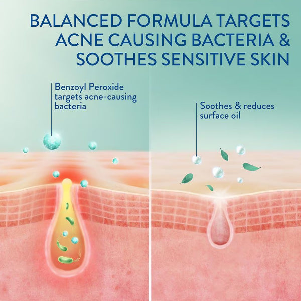 3 Pack - Cetaphil Facial Cleansers Complexion-Clearing BPO Acne Cleanser 4.2oz