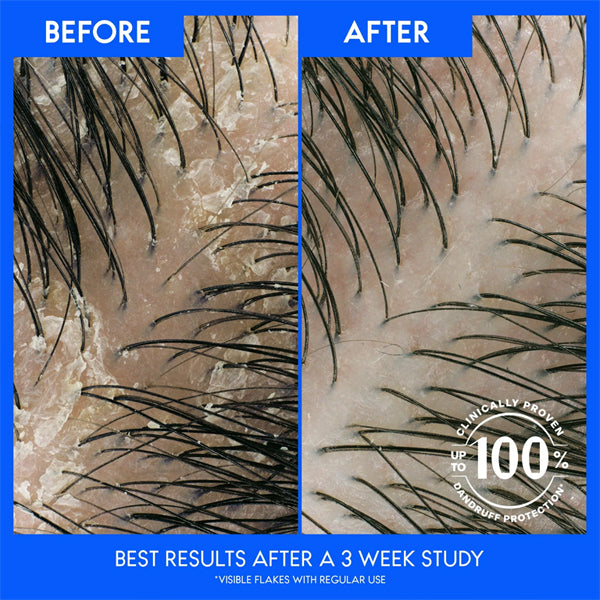 Side-by-side view of scalp with visible flakes before and after using Head & Shoulders Mens Dandruff Shampoo Sandalwood (4 Pack, 12.5oz), showing fewer flakes and a healthier scalp in 3 weeks.